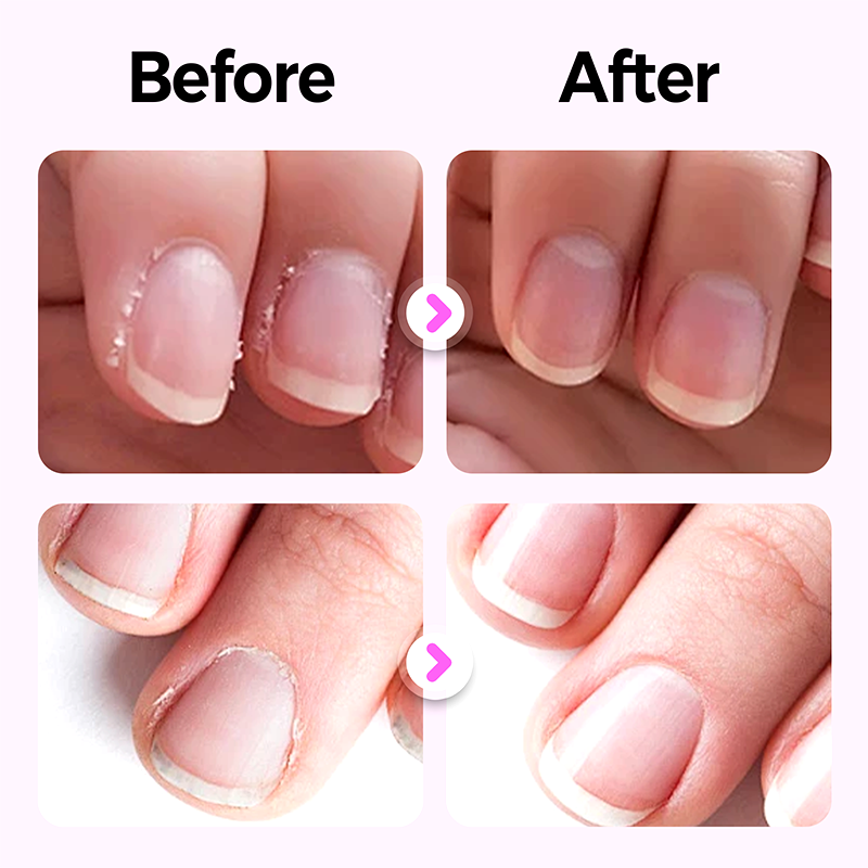 💜Offre exclusive : Achetez-en 1, Obtenez-en 1 gratuit 💜 Nouveau stylo de soin des ongles 3 en 1 – version améliorée 2025